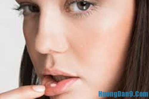Hướng dẫn cách chữa nhiệt miệng đơn giản hiệu quả